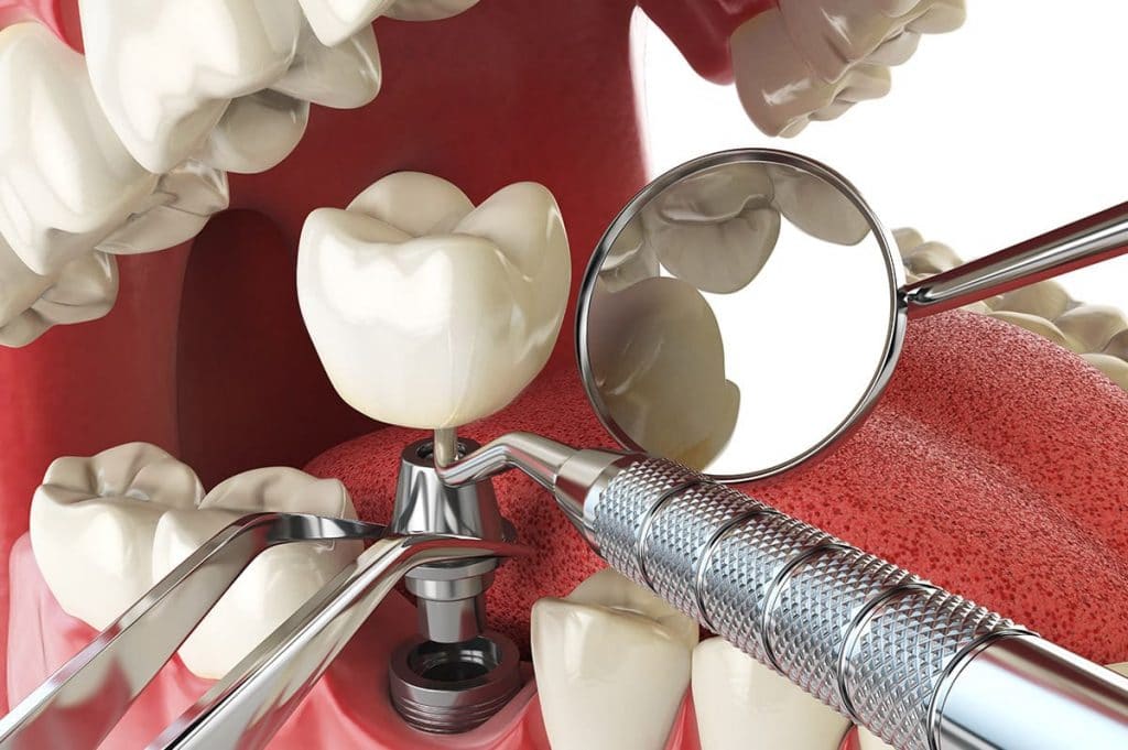 dental implant 1