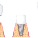 implant fiyatlari